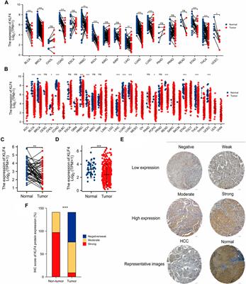 KLF4 loss in hepatocellular carcinoma: Improving prognostic prediction and correlating immune infiltrates